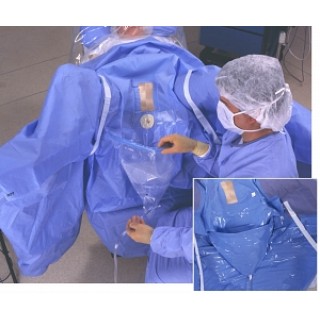 Ecolab # 1-0657 - DRAPE, SURG, GYN, LINGEMAN, 6 EA/CS